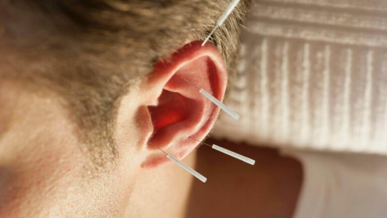 acupuncture for insomnia - auricular