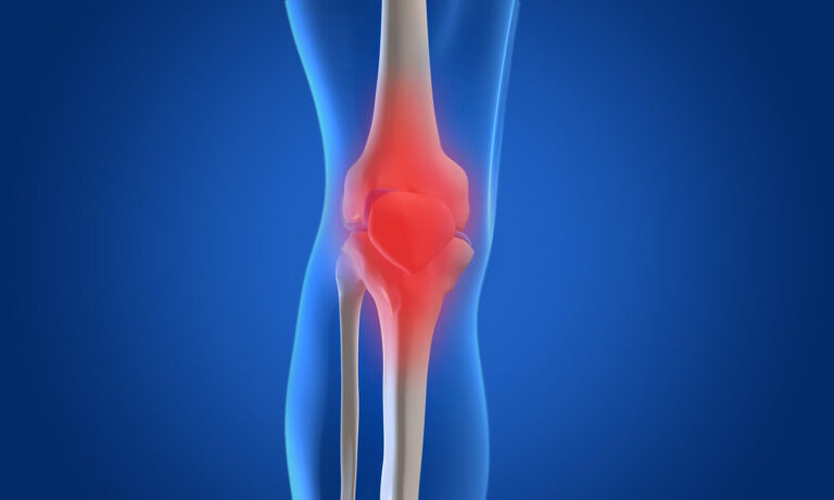 Acupuncture For Osteoarthritis