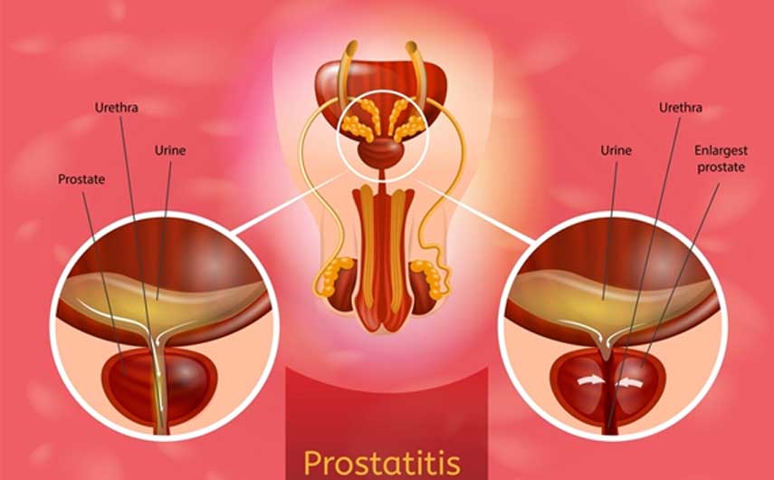 prostatitis milyen korban jelent meg