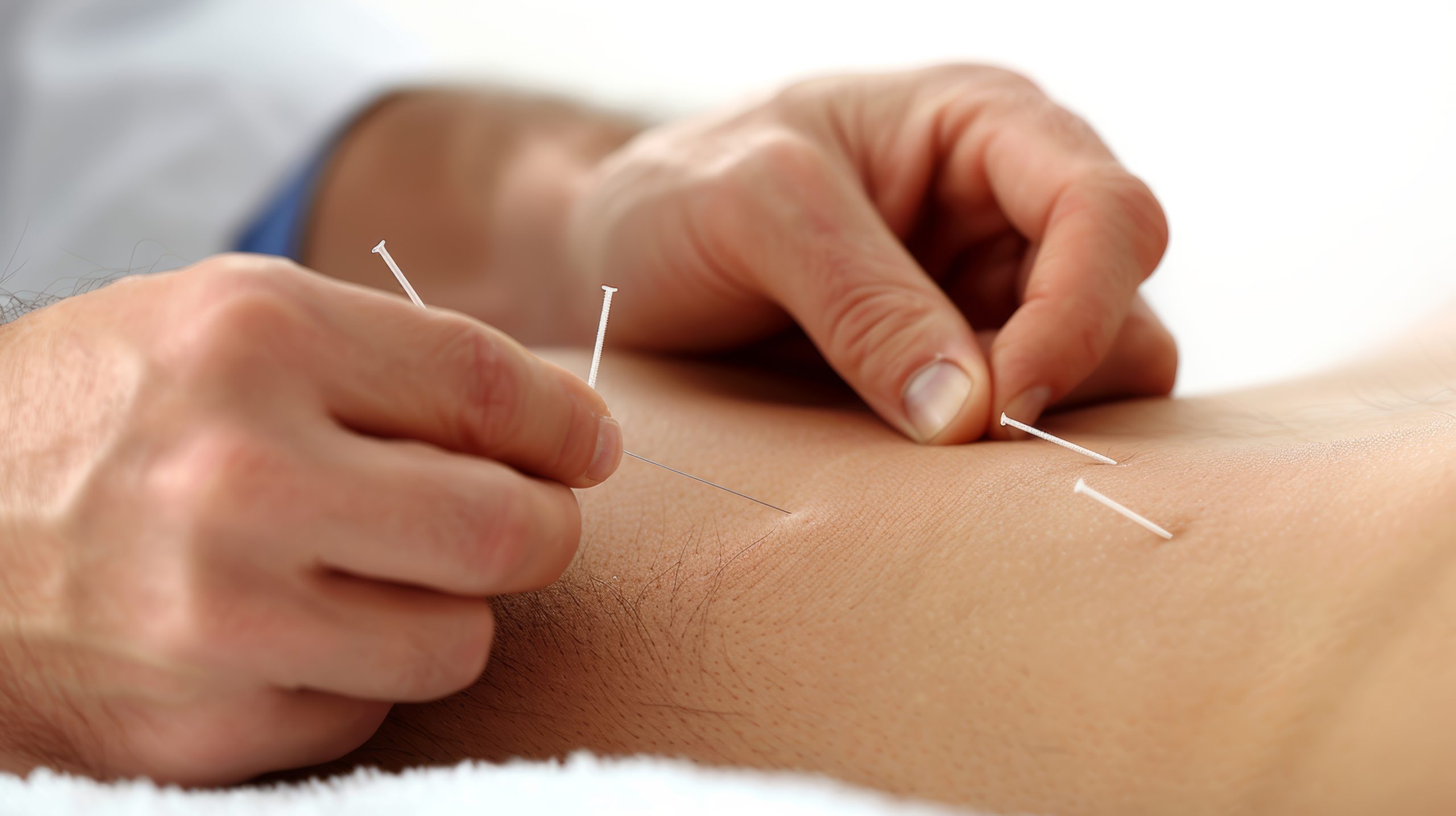 acupuncture for pain
